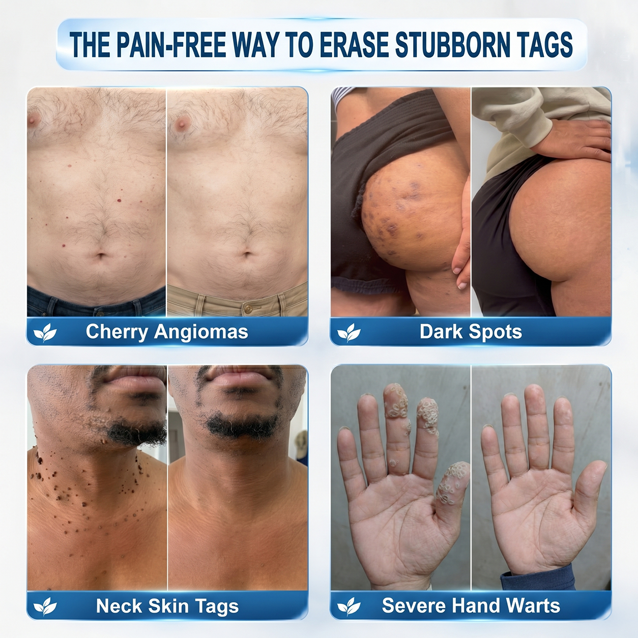 7-Day Skin Tag & Spot Eraser
