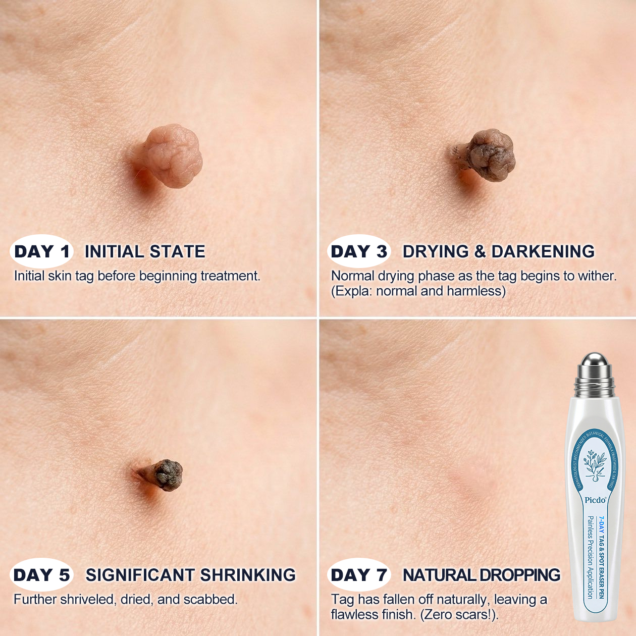7-Day Skin Tag & Spot Eraser