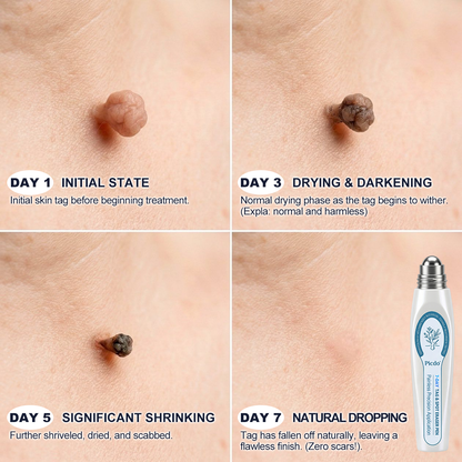 7-Day Skin Tag & Spot Eraser